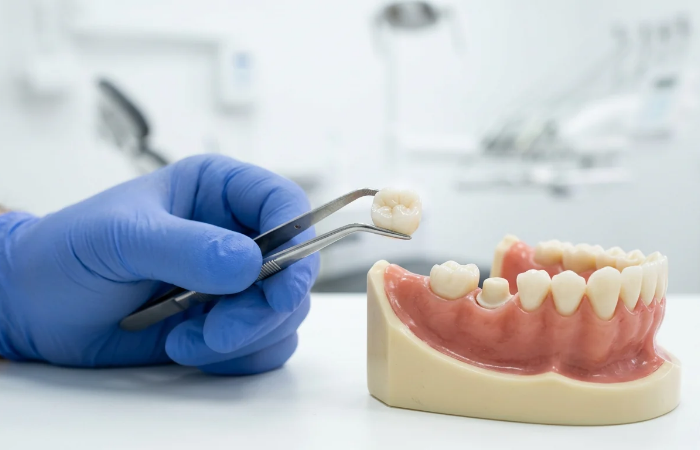 Dental crown held above a prepared tooth on a dental model